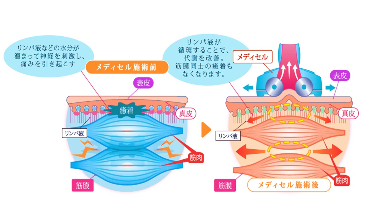 メディセル筋膜美療養について